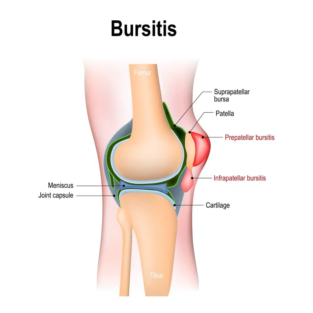 Medical Illustration of knee Bursitis