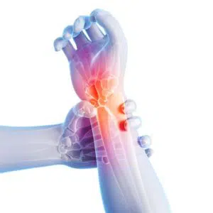 Illustration of Carpal tunnel syndrome