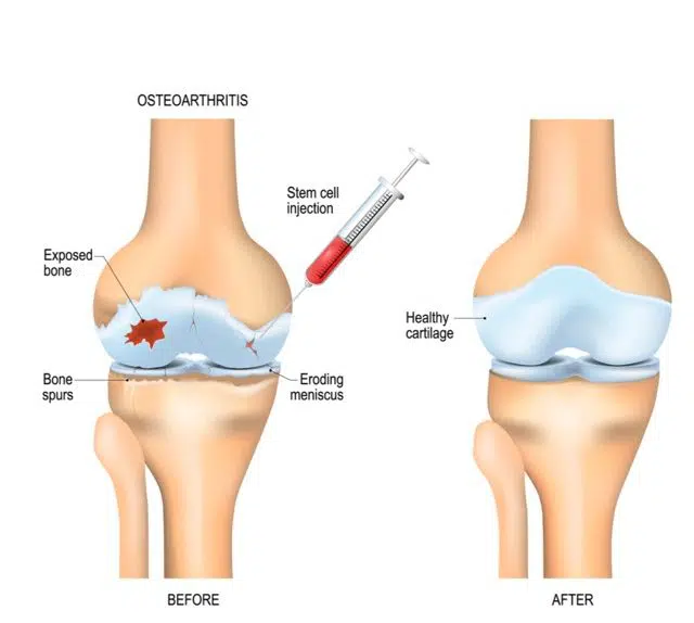 Medical illustration of stem cell therapy