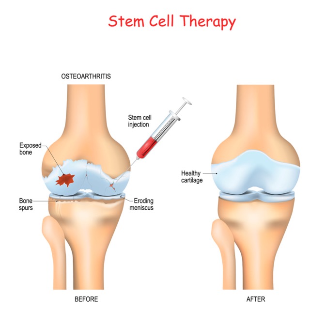 Medical illustration of stem cell therapy