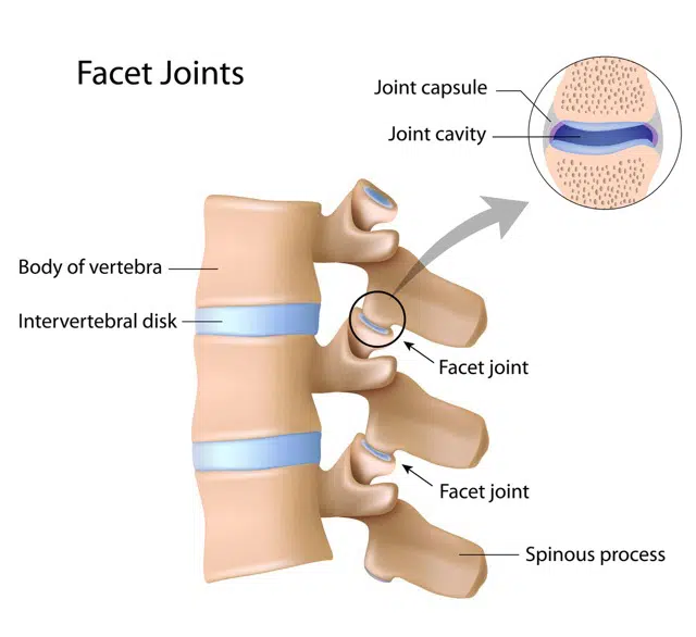 Illustration of Facet Joint Athritis