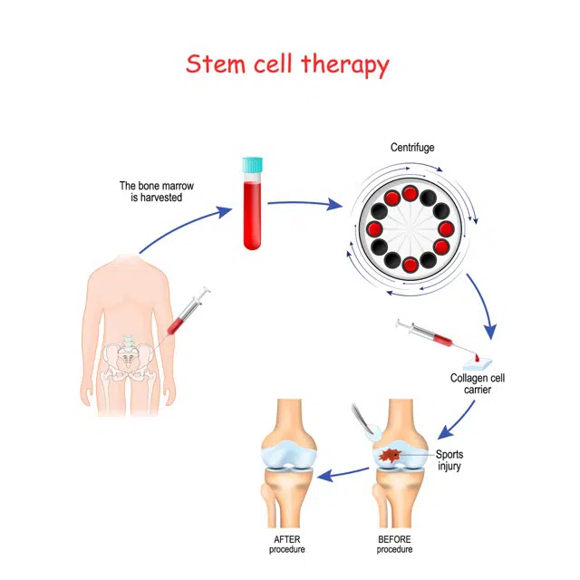 Illustration of Regenarative medicine, Stem cell therapy