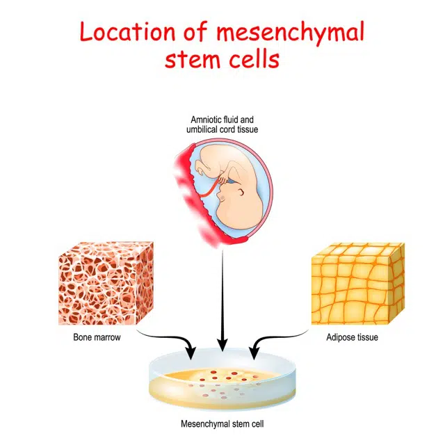 Illustration of Mesenchymal stem cell therapy
