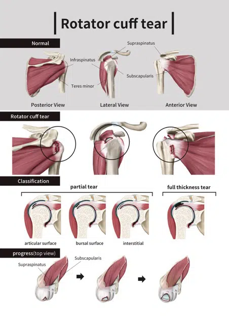 Medical Illustration explaining Rotator Cuff Tear Injury