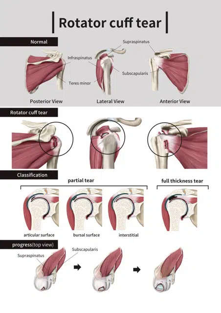 Rotator Cuff Pain The Woodlands TX