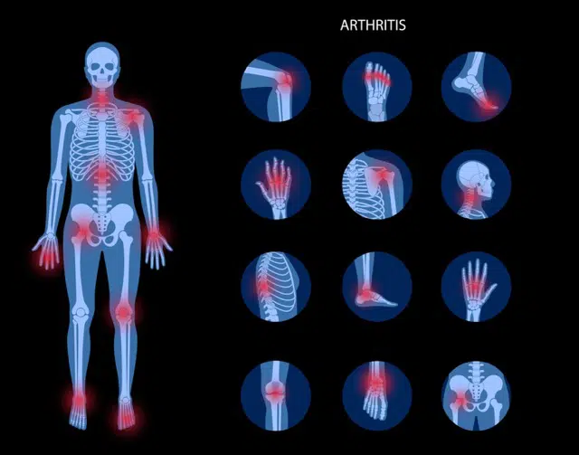 Medical Illustration of Arthritis