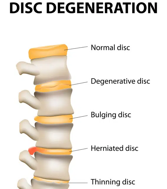 Medical illustration of Degenerative disc disease