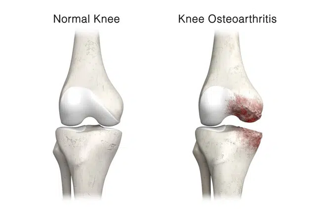 Medical illustration of knee Osteoarthrotis