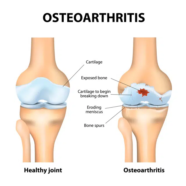 Medical Illustration of Osteoarthritis
