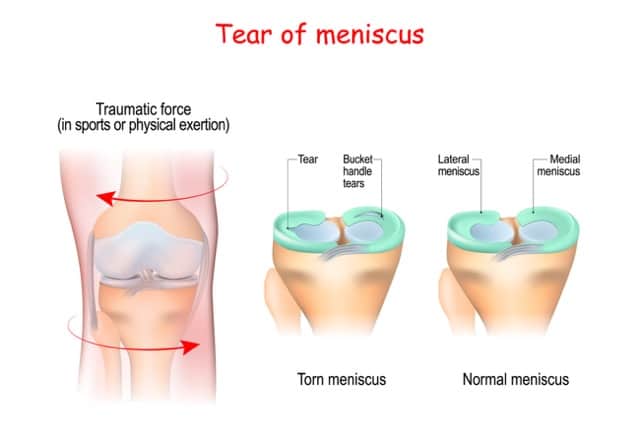 Meniscal Tear Treatment With Regenerative Medicine Hsrm 