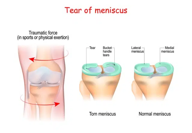 Medical illustration of a knee with Meniscal Tear