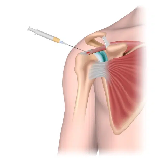Medical illustration of a stem cell injection in a shoulder 